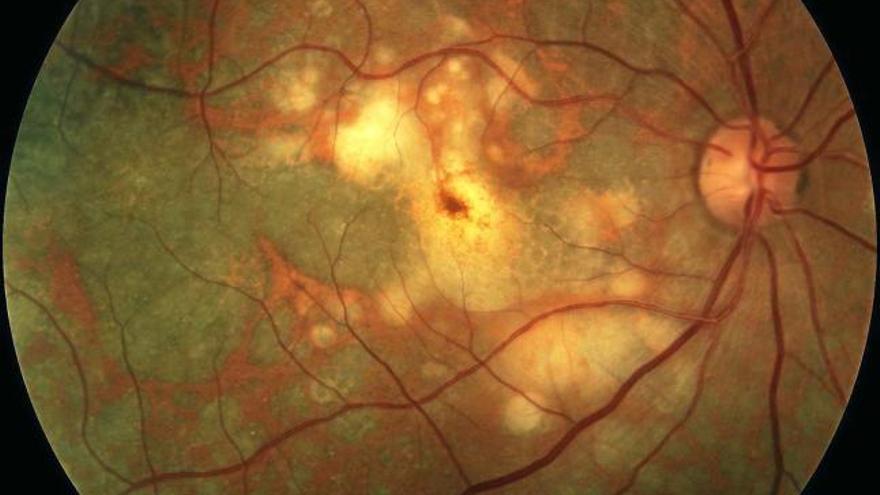 La degeneració macular és el trastorn de ceguesa més important associat a l&#039;edat i l&#039;envelliment