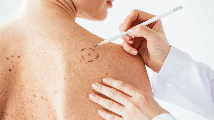 Melanoma: Ocho medidas para prevenir el cáncer de piel más agresivo