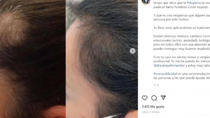 Un rostro muy conocido en España confiesa que tiene  alopecia, como la mujer de Will Smith