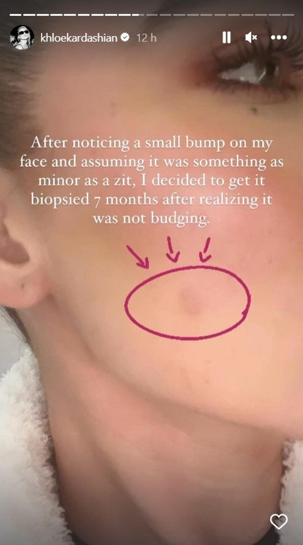 Khloé Kardashian enseña la cicatriz de la biopsia