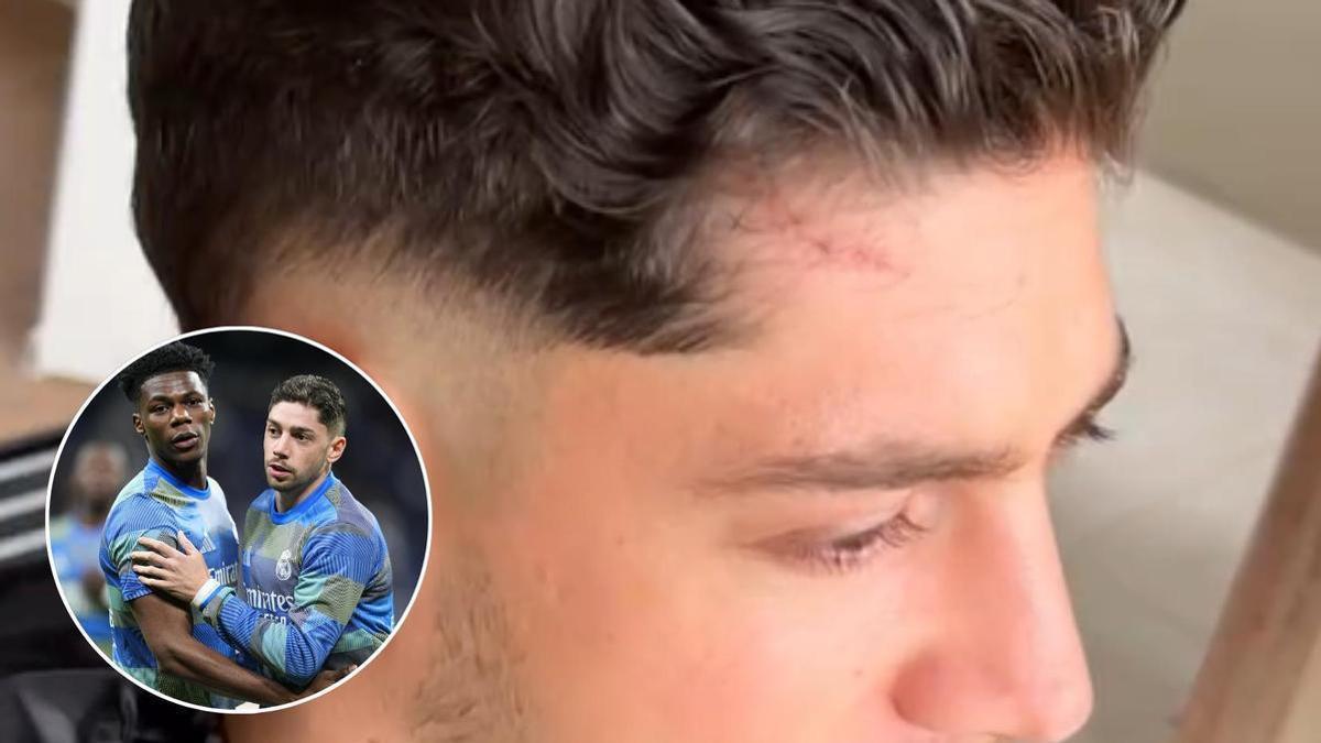La cicatriz de Fede Valverde que no pasa desapercibida tras su choque con Tchouaméni