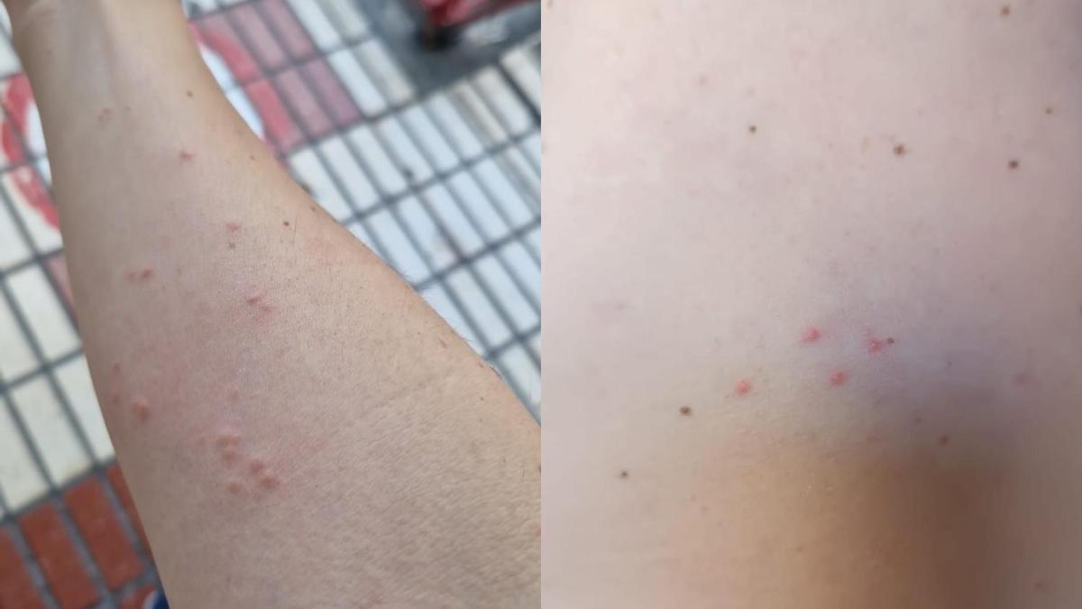 Profesionales afectados por las picaduras de chinches o pulgas