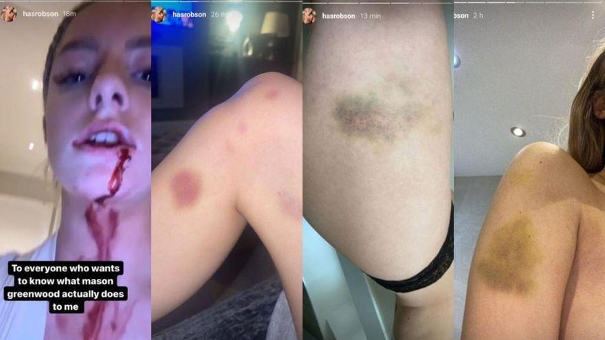Capturas del Instagram de Harriet Robson en las que muestra las señales de la agresión.