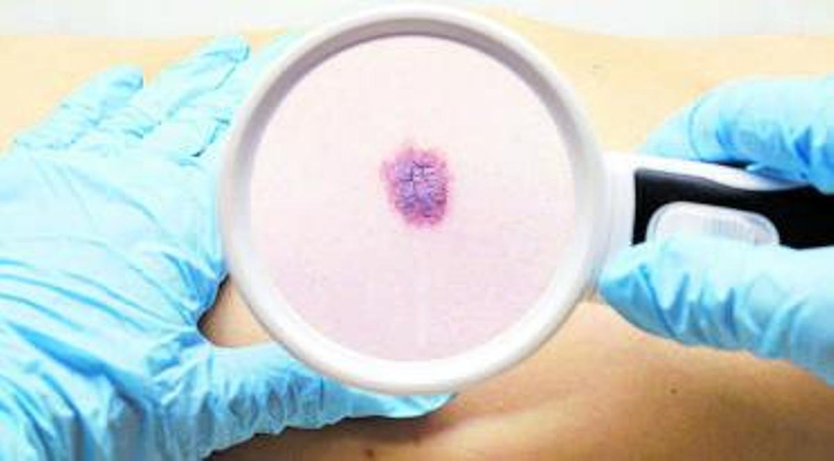 La mayoría de los melanomas suceden en la piel expuesta al sol y hay también un mayor riesgo de melanoma en las personas que usan cabinas de rayos UVA artificiales.