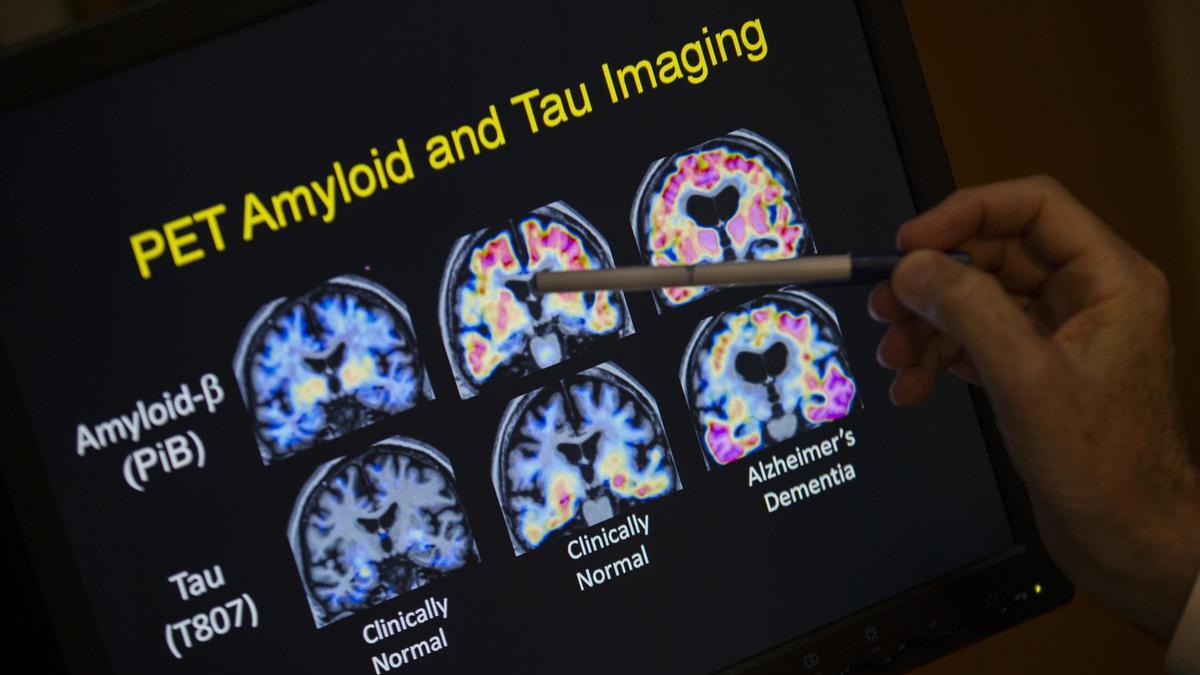 Un médico revisa los resultados de un escáner realizado a un paciente con alzhéimer.