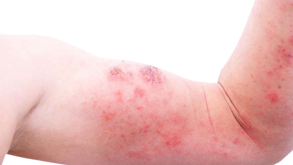 Un fármaco biológico, capaz de reducir el picor de la dermatitis atópica en niños