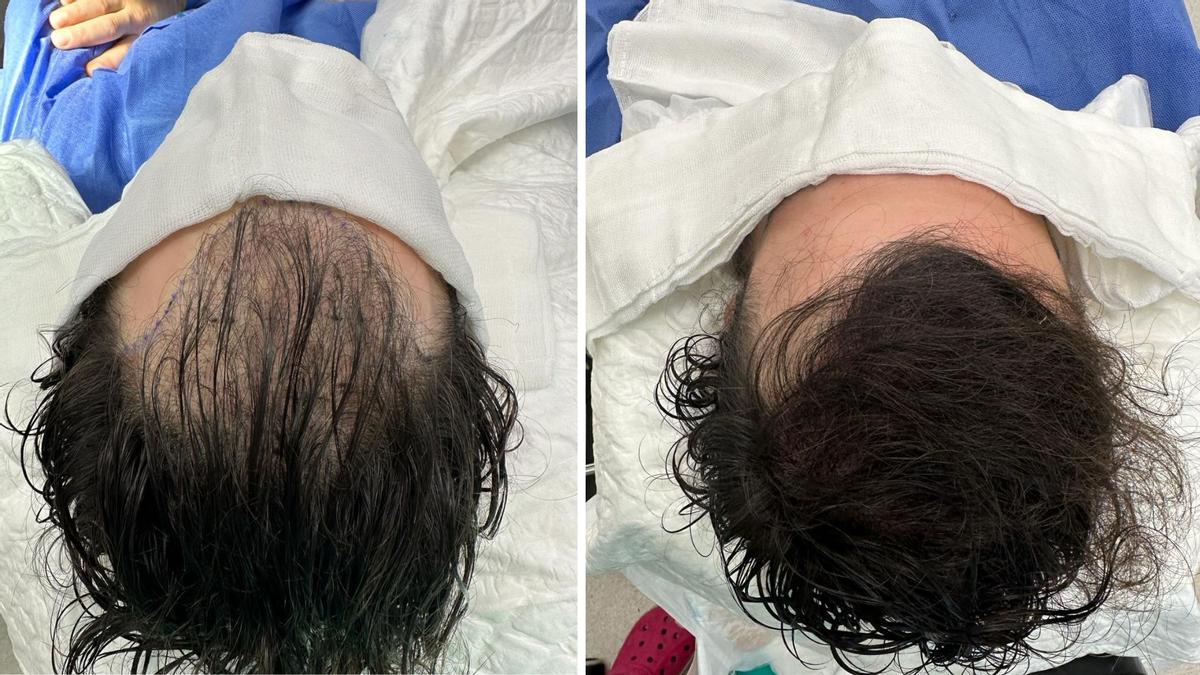 El antes y el resultado inmediato después de un trasplante capilar con la técnica de Long Hair.