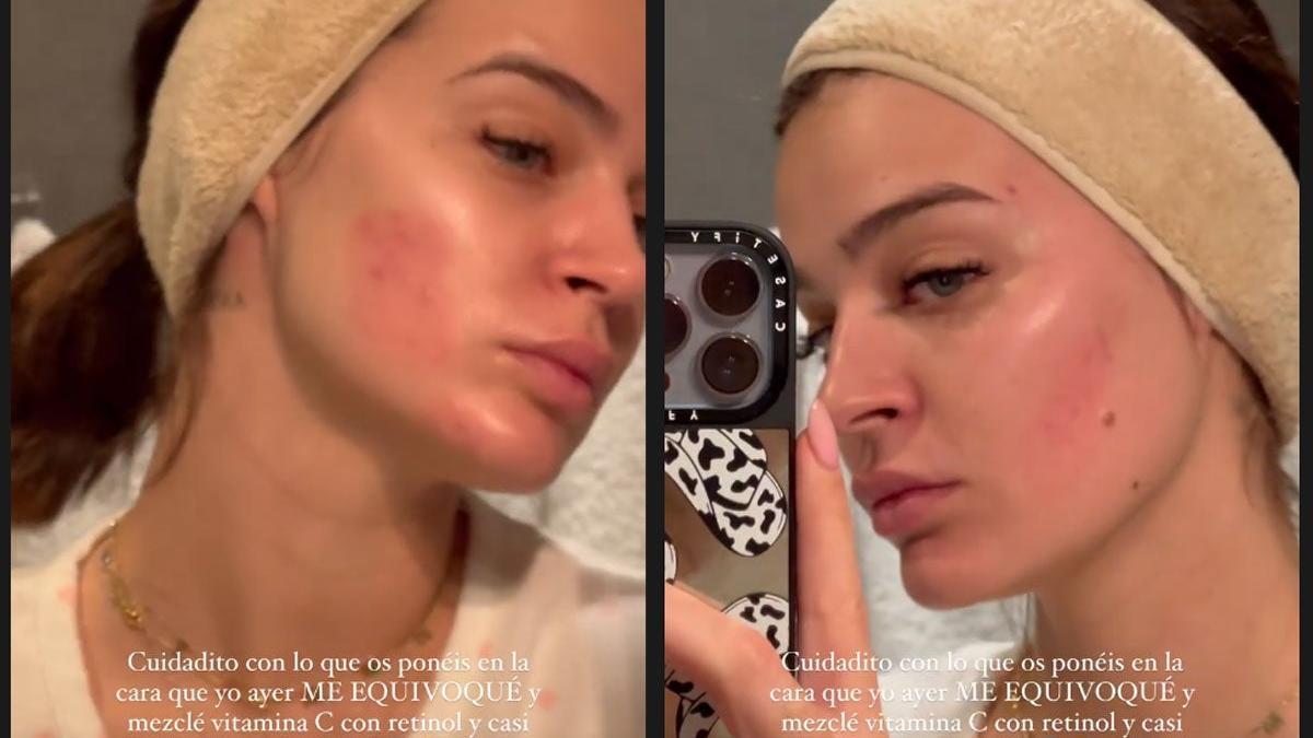 Laura Escanes se quema la cara con una mezcla de retinol y vitamina C