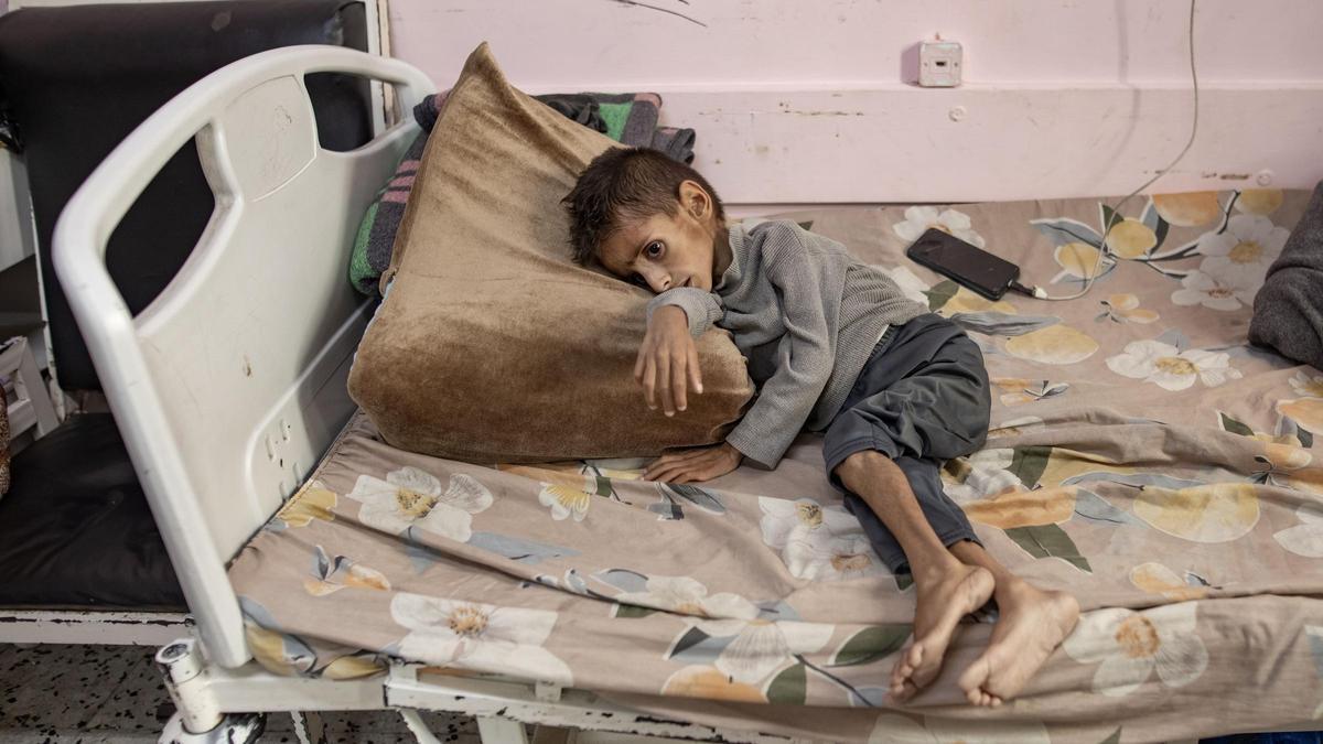 Un niño en Gaza afectado por desnutrición.