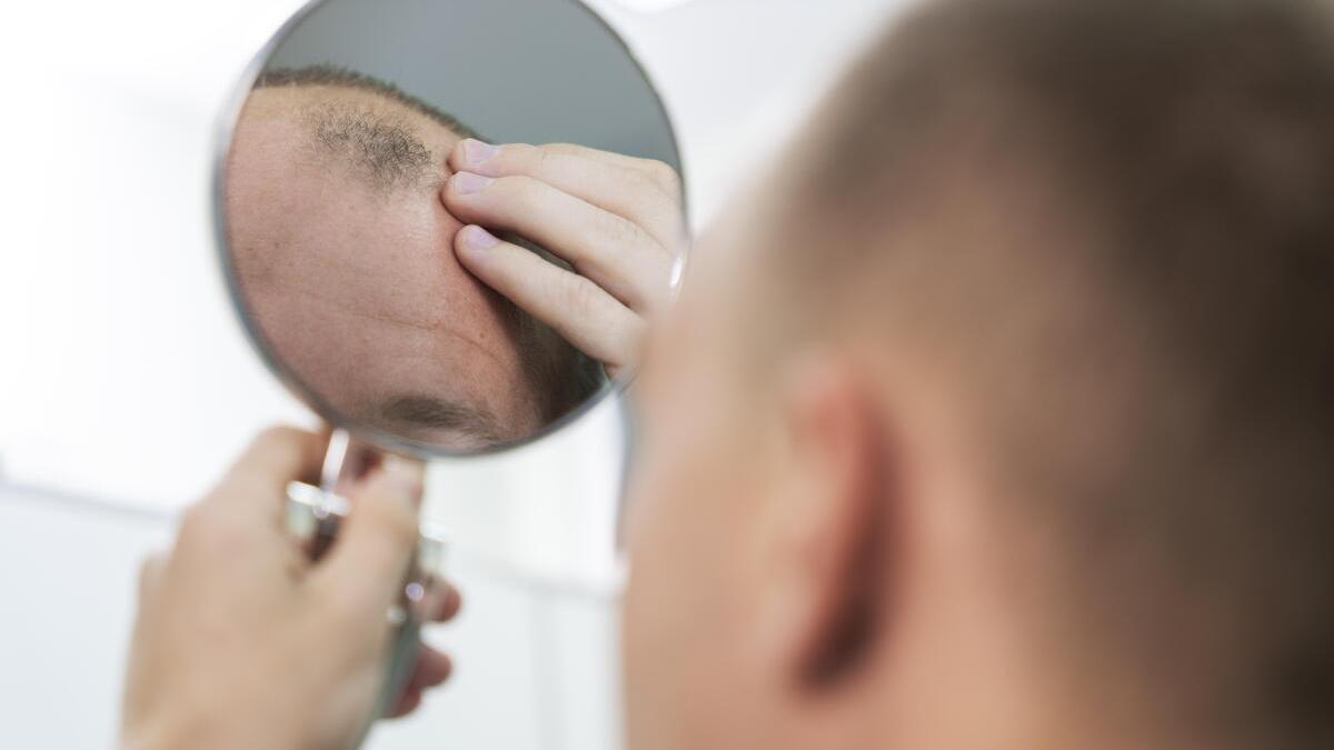 Olumiant: Así es el primer fármaco aprobado contra la alopecia areata