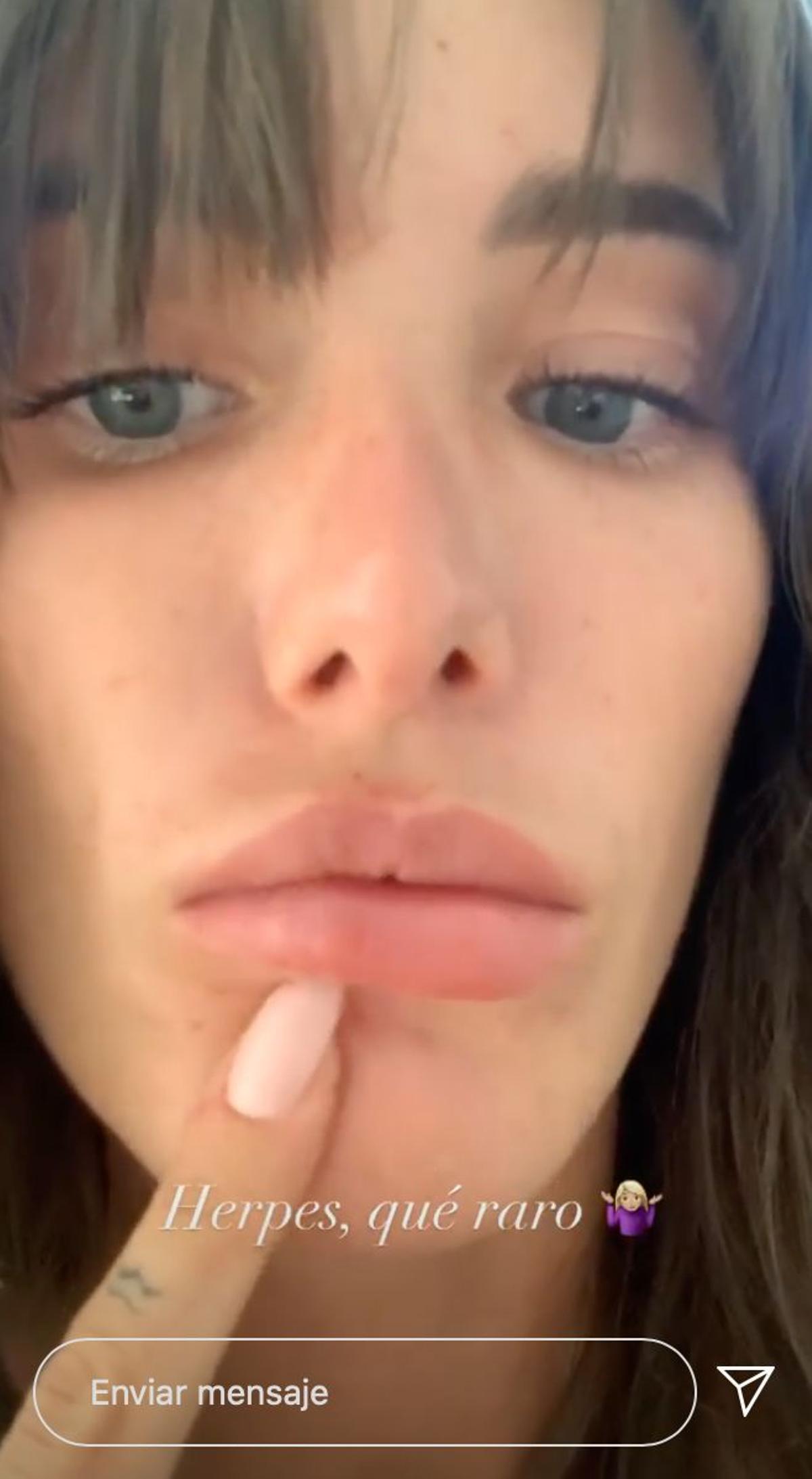Marta López Álamo con herpes en los labios