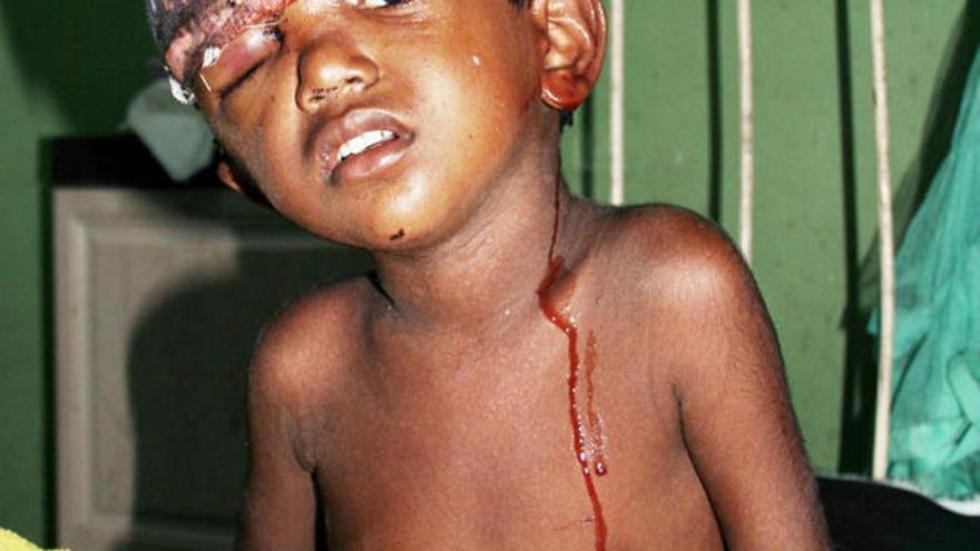 Un  niño tamil herido en un hospital cerca de la ciudad de Anuradhapura, en el norte de Sri Lanka.