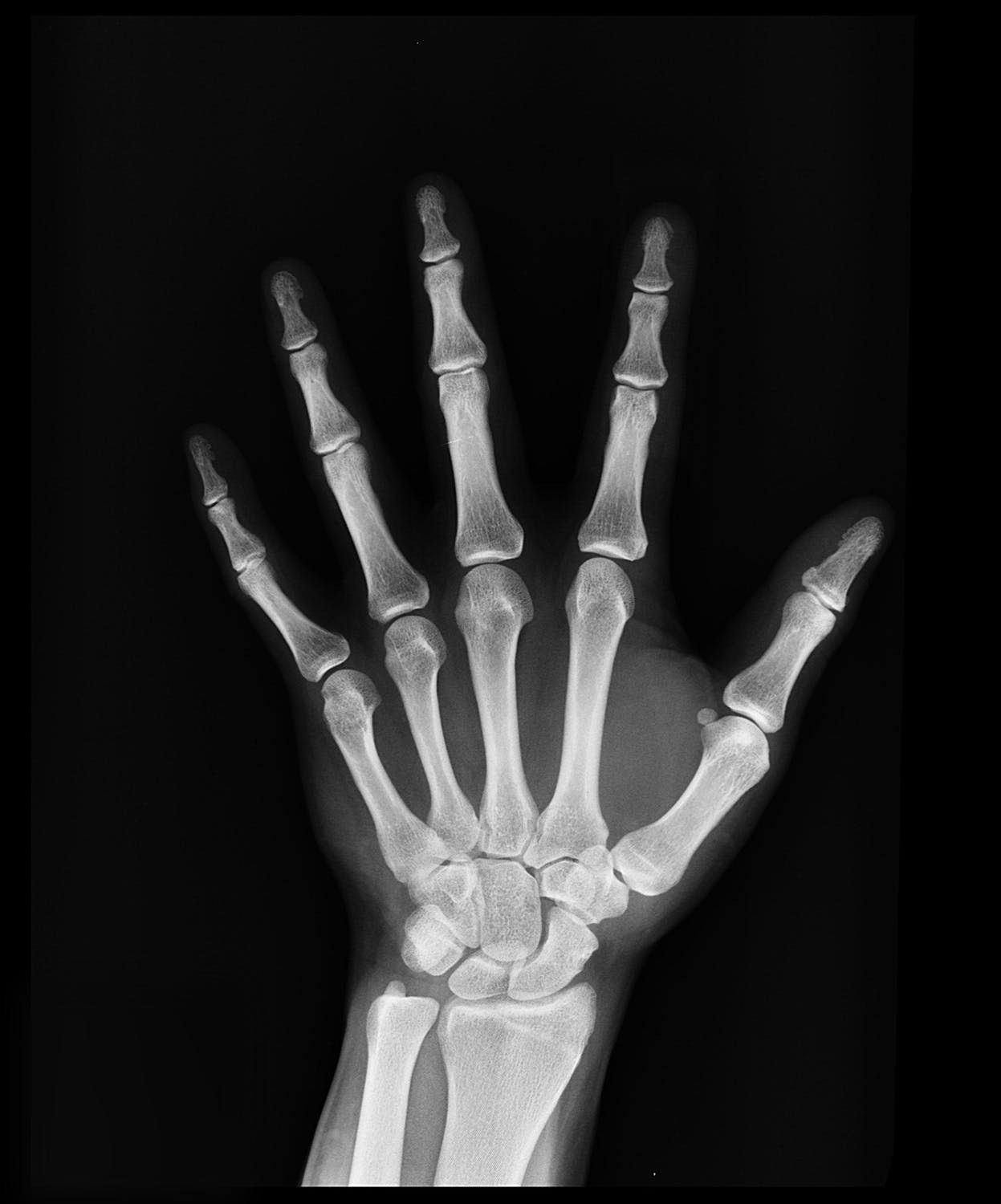 Archivo - Radiografía de mano
