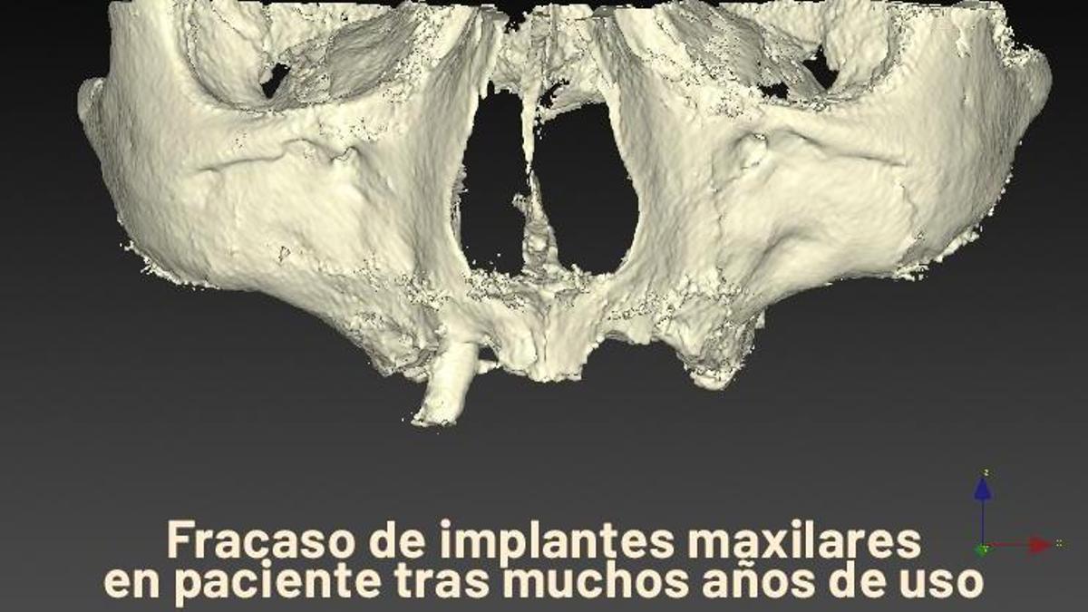 Fracaso de implantes maxilares en paciente tras muchos años de uso.
