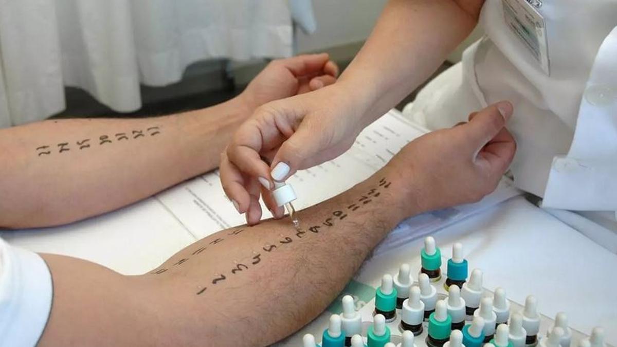 Ein Patient auf Mallorca wird einem Allergie-Test unterzogen