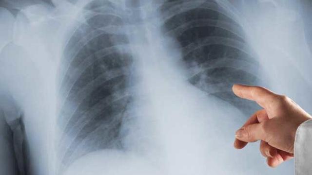 La fibrosis quística es una enfermedad hereditaria que afecta a los pulmones.