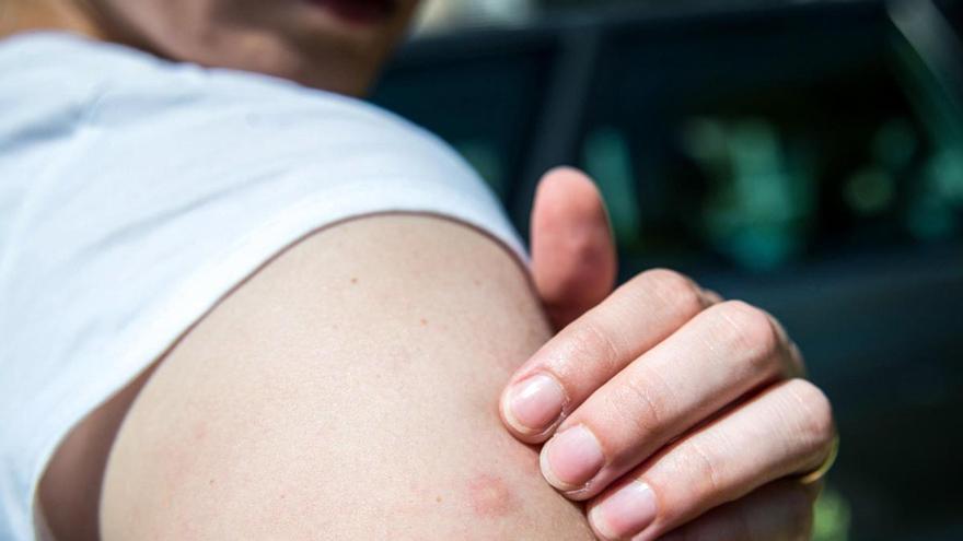 Von Spucke bis Salbe: Was hilft bei Mückenstichen?