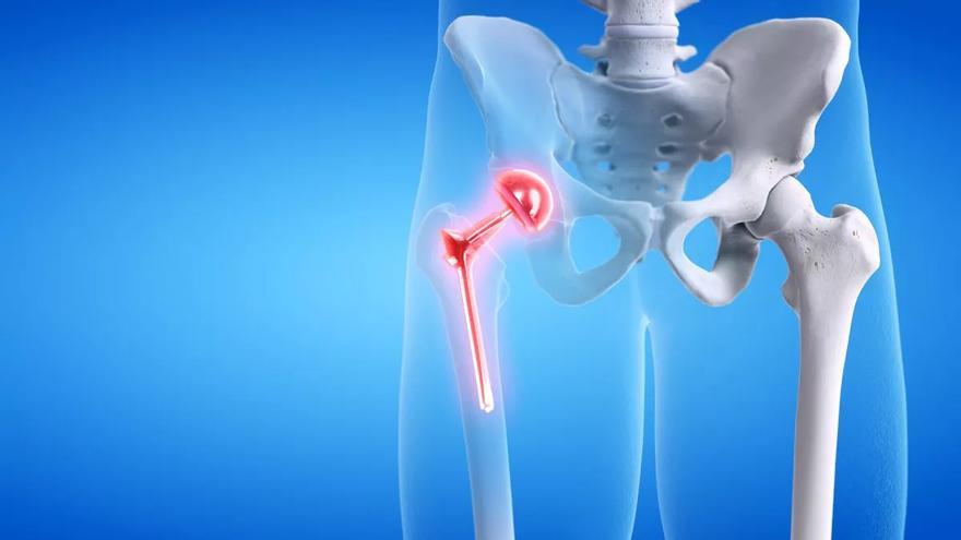 Cómo recuperarse correctamente tras una artroplastia de cadera