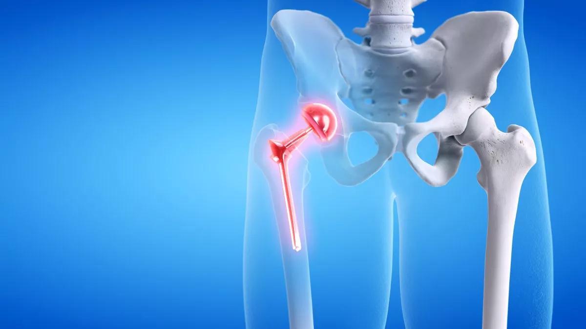 El reemplazo total de cadera, también llamado artroplastia de cadera, se lleva a cabo cuando el hueso y el cartílago de la cadera se encuentran dañados
