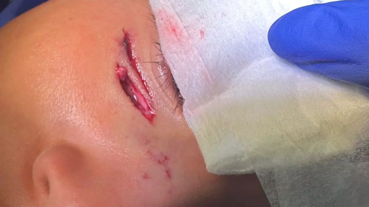 Un pitbull suelto muerde en la cara a una niña de Zaragoza: "Su cara estaba llena de sangre"
