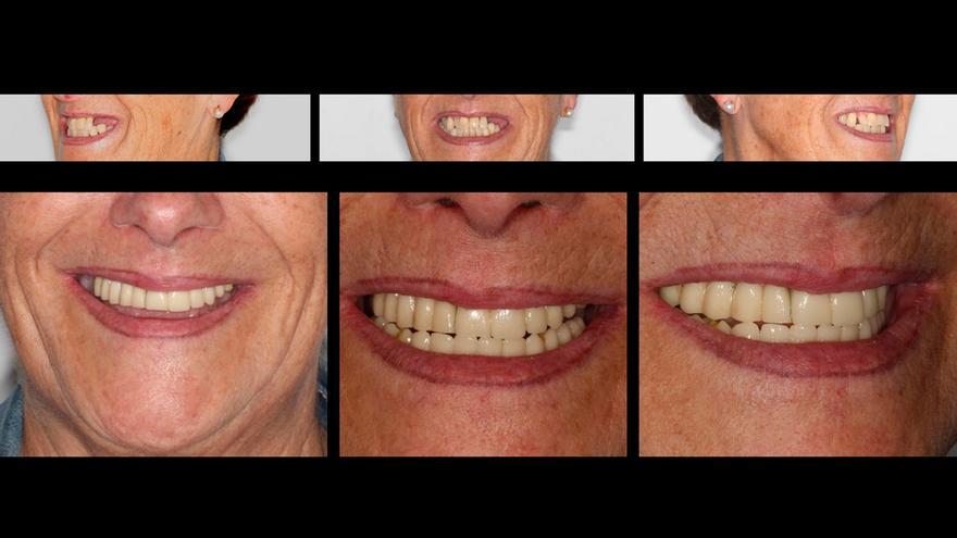 El éxito de los implantes dentales depende de una regeneración ósea previa en muchas ocasiones