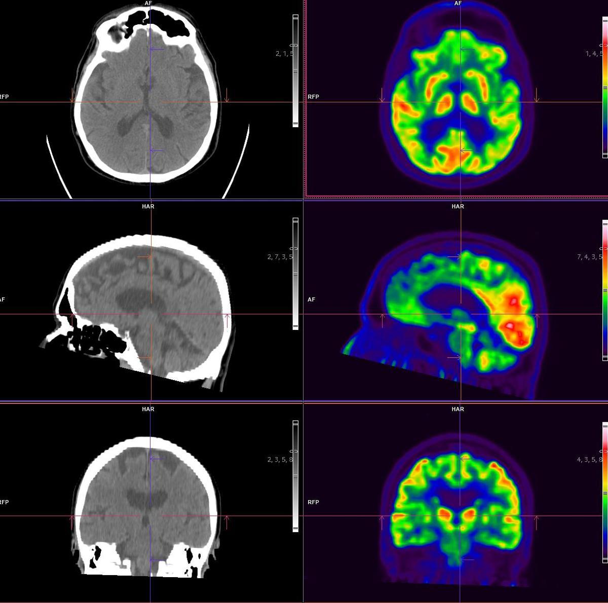 Das digitale PET-CT ist die Referenztechnik für die Diagnose neurodegenerativer Erkrankungen wie Alzheimer und anderer Demenzen. Eine frühzeitige Diagnose eröffnet den Weg zu einer personalisierten Behandlung.