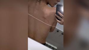 Imagen de las lesiones en la espalda de Valeria Quer publicada en su perfil de Instagram. 