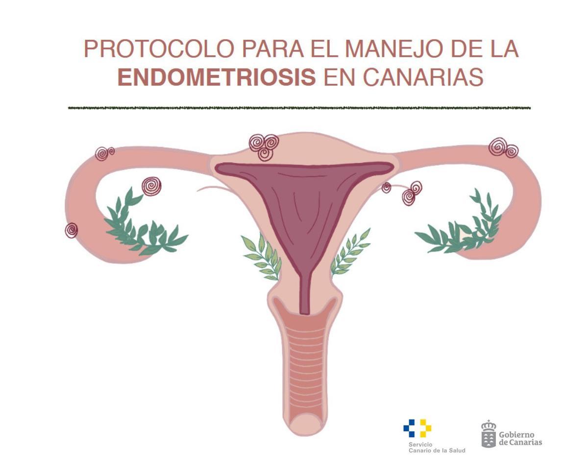 Manejo de la endometriosis en Canarias