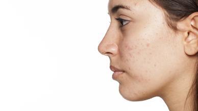 ¿Sufres acné adulto? Estos son los trucos con el que lo combatirás