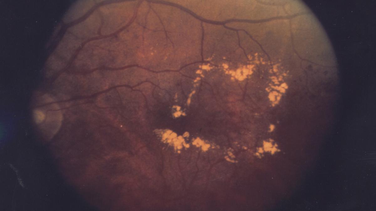 Así se ve en el ojo la grave lesión del edema macular