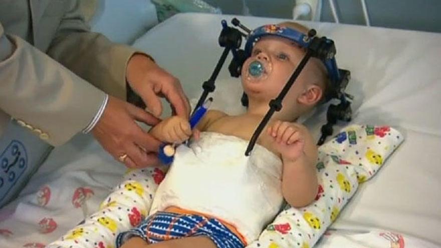 Médicos australianos unen el cráneo de un bebé a su cuello