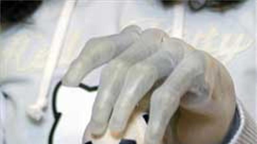 Implantan una mano biónica a una niña de 12 años