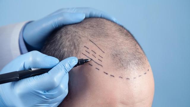 El 90% de los casos de alopecia son de origen androgénico