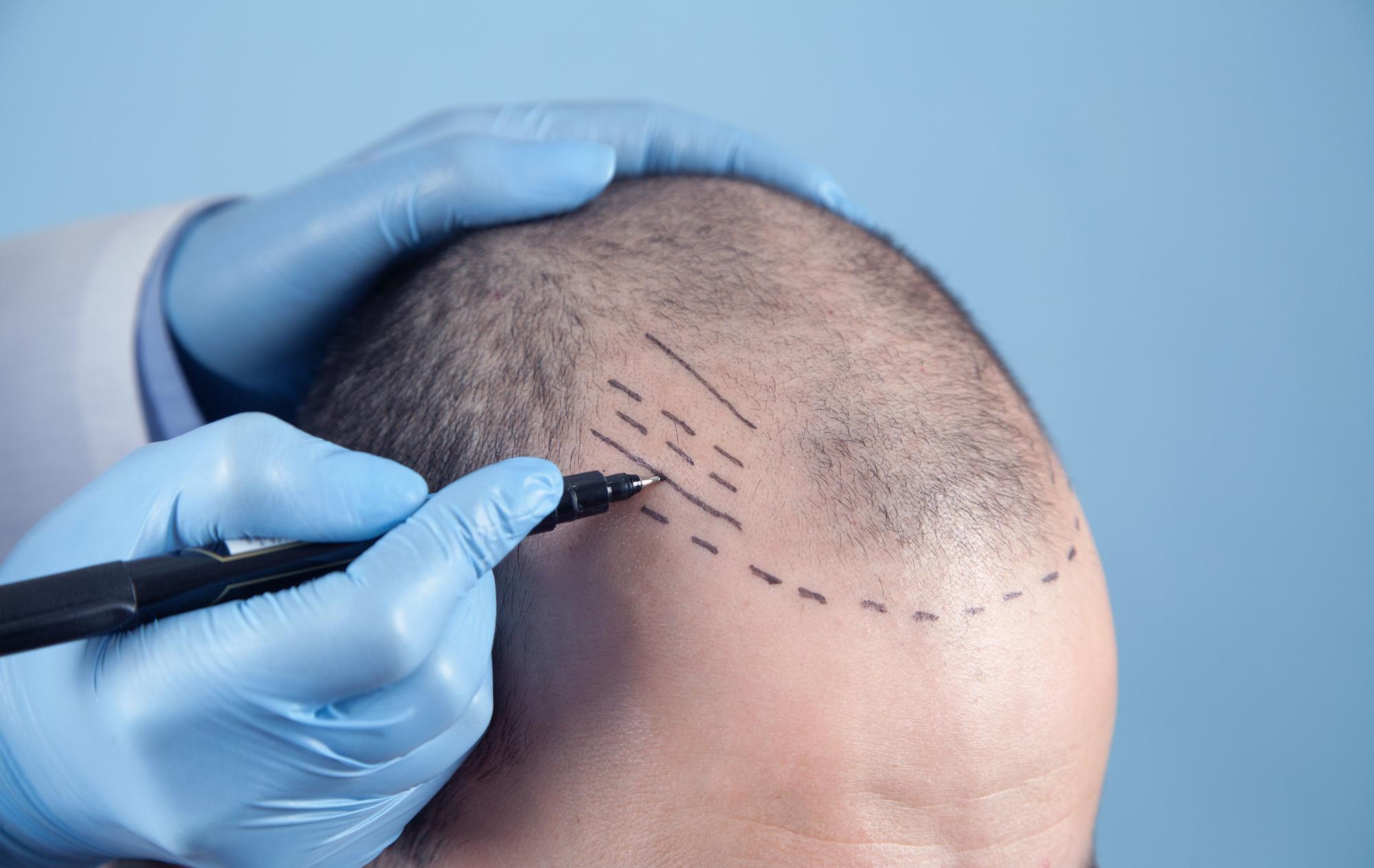 El 90% de los casos de alopecia son de origen androgénico