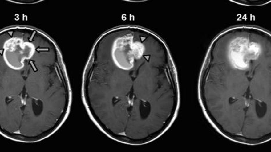 Radiòlegs gironins milloren el diagnòstic d&#039;uns tumors cerebrals