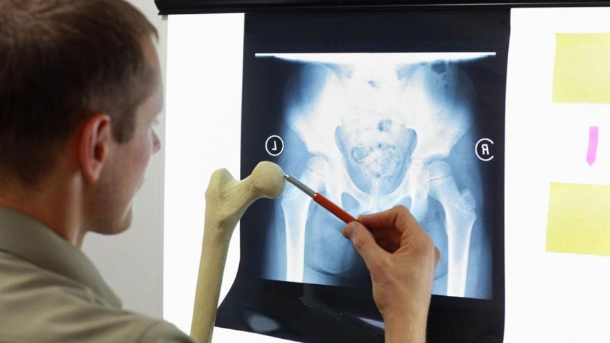 Es posible que el fémur se rompa debido a una osteoporosis severa