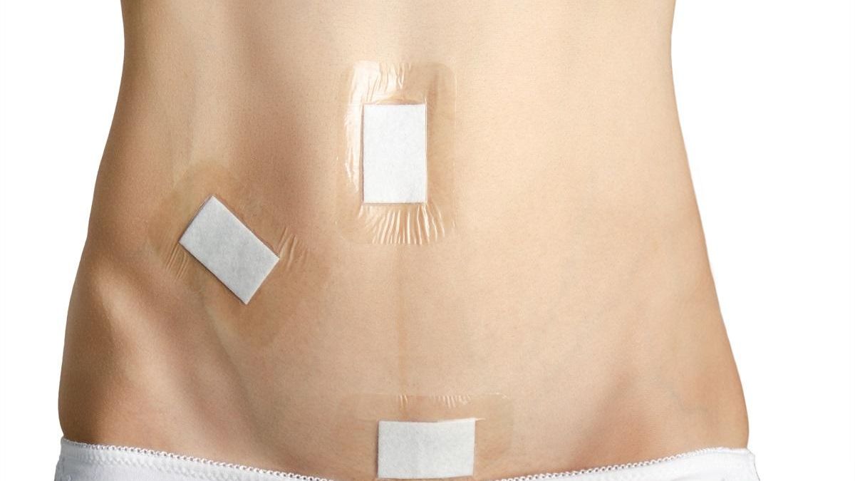 La apendicectomía laparoscópica es una intervención que dura entre 30 y 60 minutos en casos simples. Si se trata de una apendicitis complicada, puede prolongarse algo más.