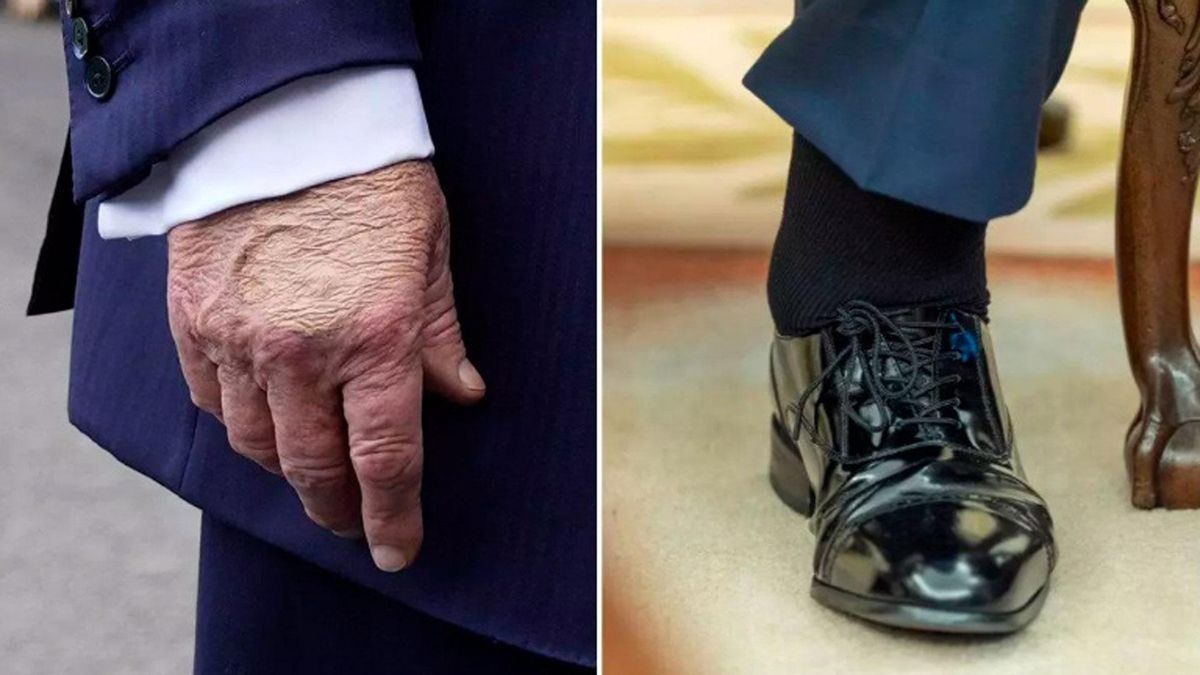 El presidente padece insuficiencia venosa crónica y por eso se le hinchan con frecuencia manos y piernas