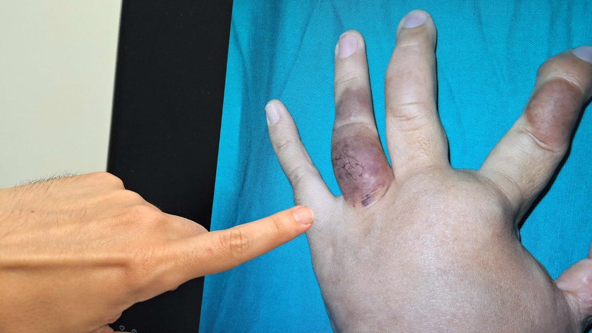 Un paciente con una malformación vascular en una mano.