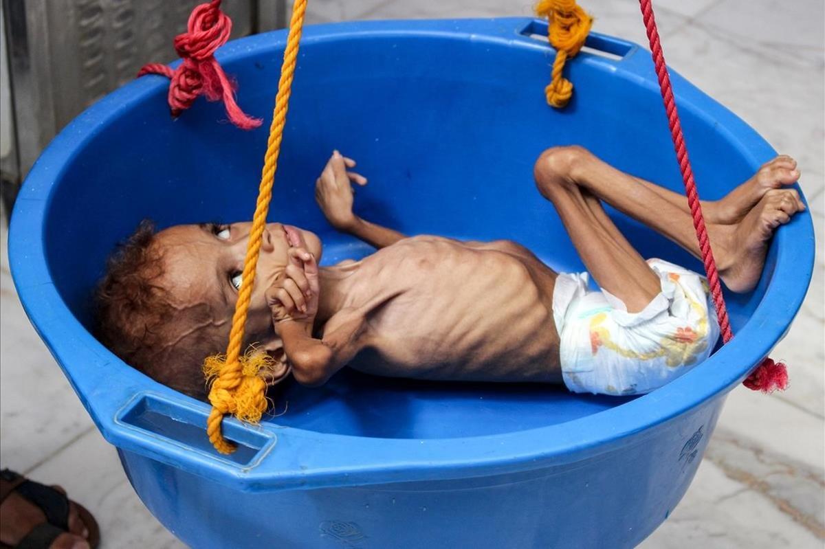 Bassem Mohamed Hassan, niño yemení de dos años que sufre de desnutrición, se mide en un hospital en el distrito norte de Abs. El conflicto entre el gobierno y los rebeldes Huthi ha llevado al pais al borde de la hambruna.