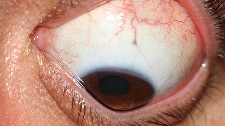 El queratocono produce una pérdida paulatina de visión asociada a miopía y astigmatismo