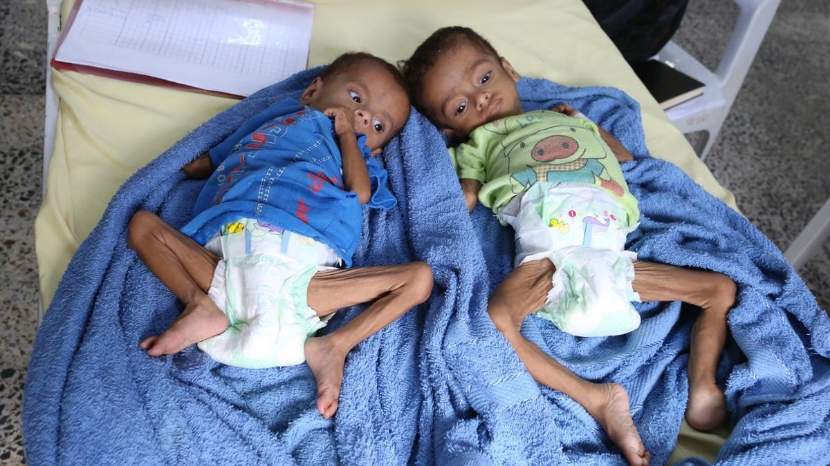Dos niños que sufren diarrea y anemia son atendidos en un centro sanitario en Yemen.