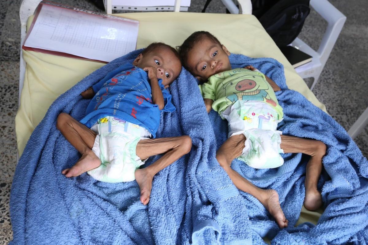 Dos niños que sufren diarrea y anemia son atendidos en un centro sanitario en Yemen.