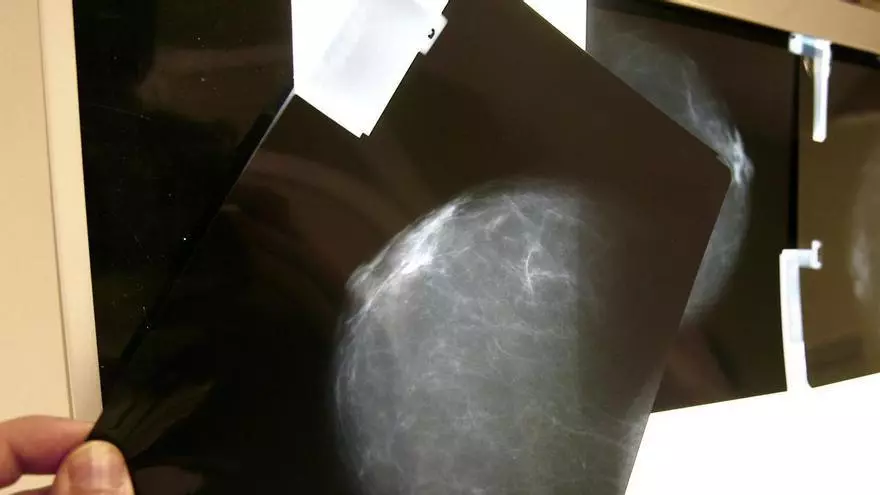 En España la mortalidad por cáncer de mama ha caído más de un 40% en 30 años