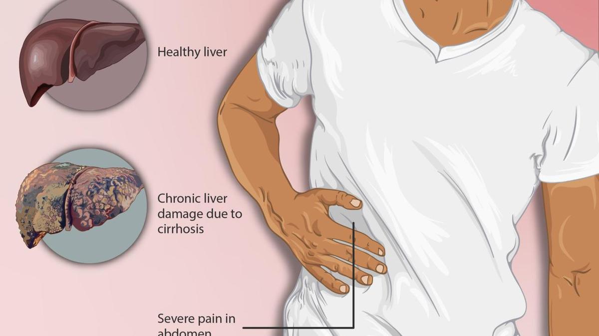 Representación de un paciente con cirrosis. Se muestra un hígado dañado en comparación con un hígado sano