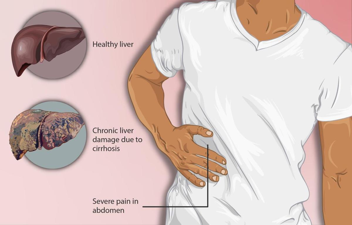 Representación de un paciente con cirrosis. Se muestra un hígado dañado en comparación con un hígado sano