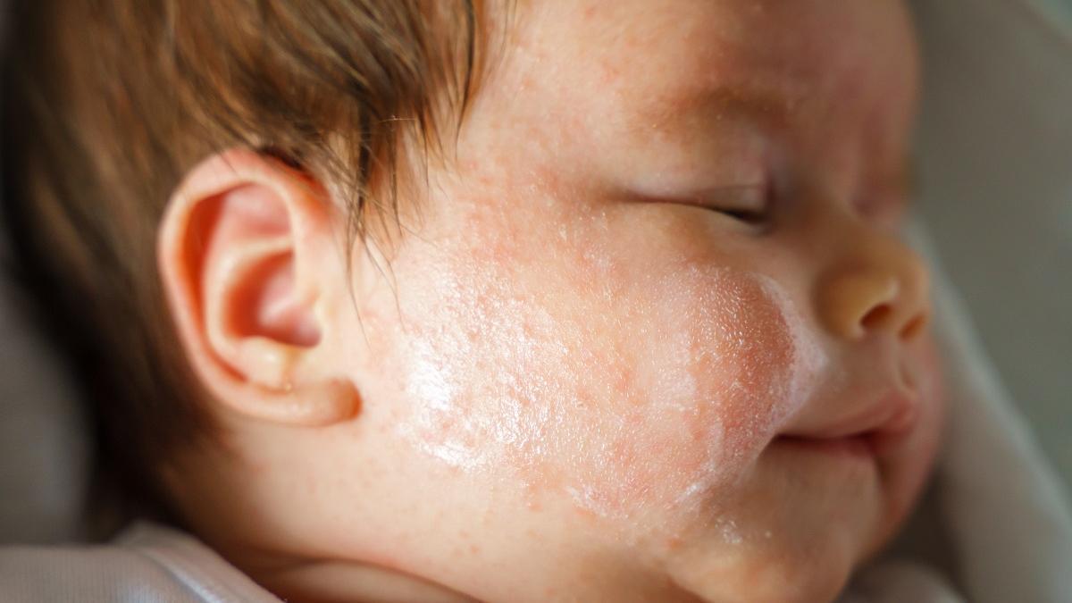 Dermatitis atòpica en nadons