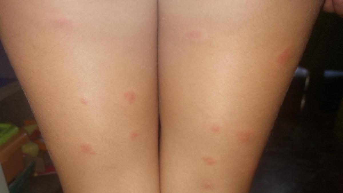 Picaduras sufridas por una niña.