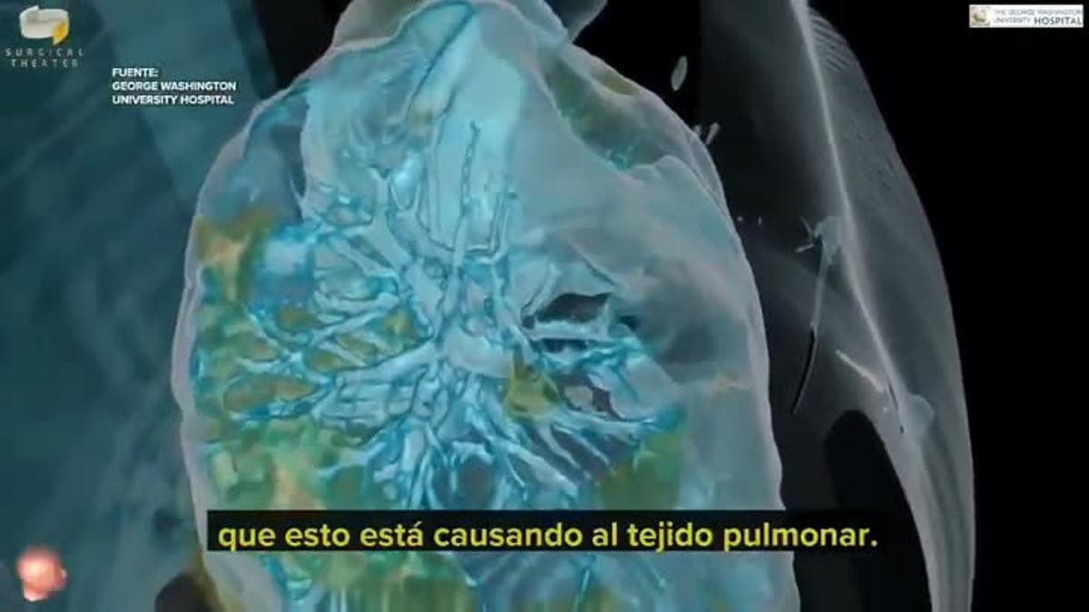 Así afecta el coronavirus a los pulmones