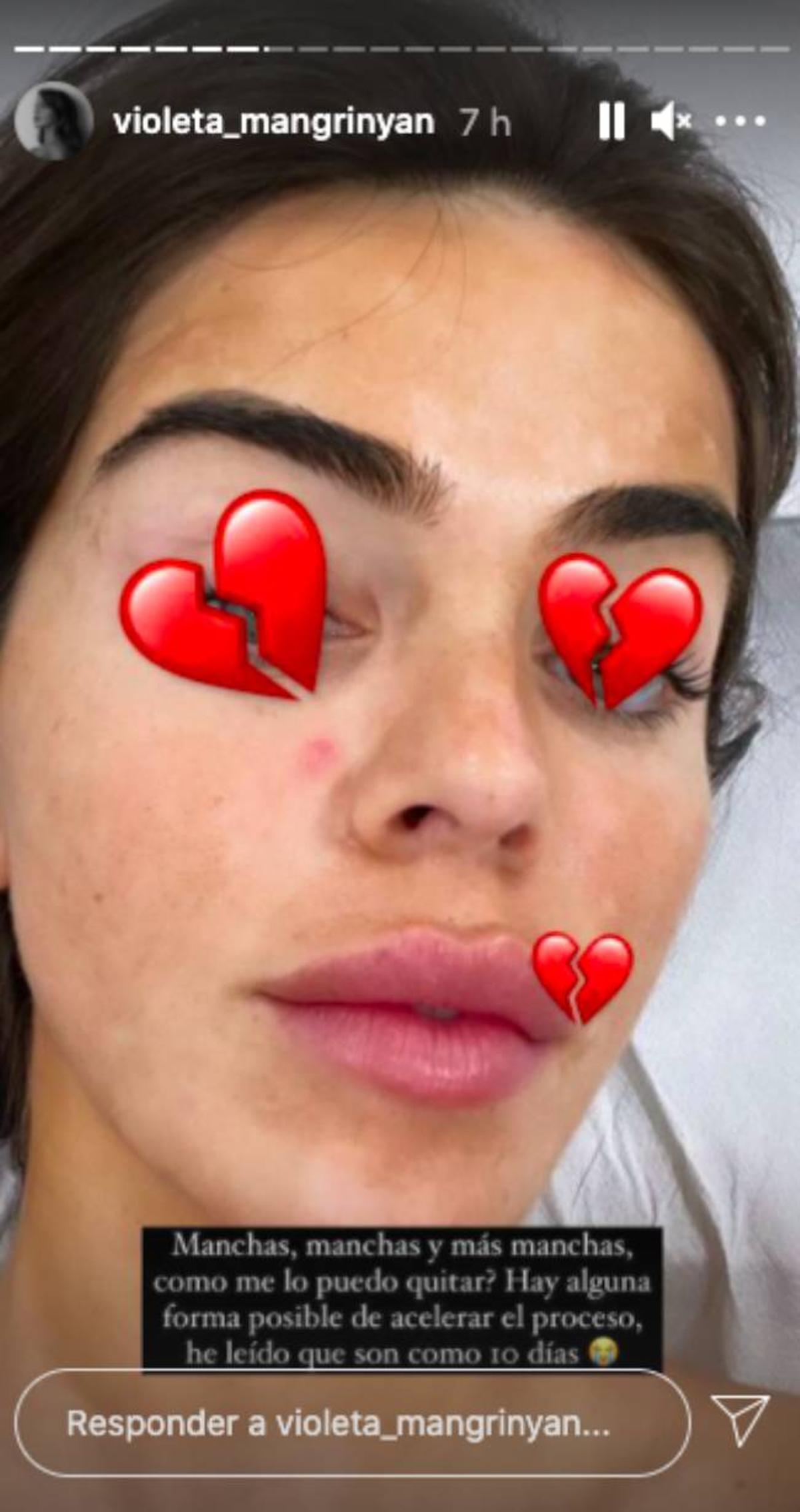 Violeta Mangriñán con la cara llena de manchas por el autobronceador